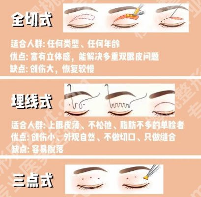 吴小蔚医生手术费用是多少?2026收费标准更新!全切双眼皮5100元左右