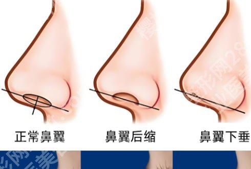 连凯峰隆鼻怎么样？坐诊医院及26年价格表曝光！
