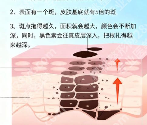 湛江哪里有皮秒激光可以治疗？附医院详情排名排行名单及2026新价格表一览！
