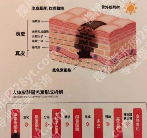 皮秒祛斑和激光祛斑有什么区别?附价格分析及原理对比！