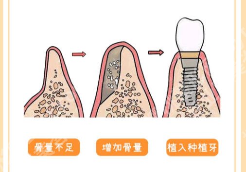 徐州种牙哪家医院好?top榜前五名单揭晓!市中心医院榜上有名