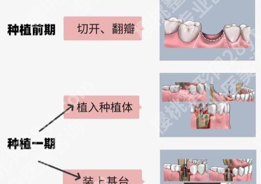 无锡全口种植牙哪个医院好？热门医院请收藏