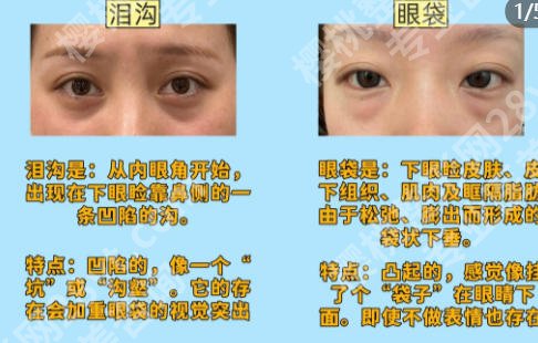 芜湖去眼袋手术哪里好？严选top5医院榜单公示小白必看！