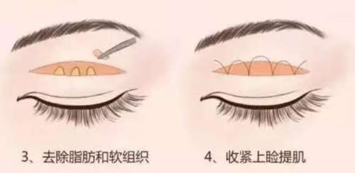 双眼皮 双眼皮