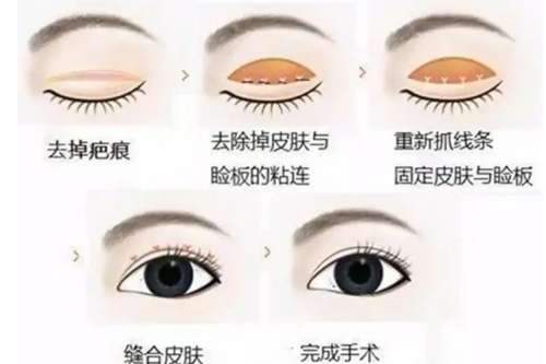 双眼皮