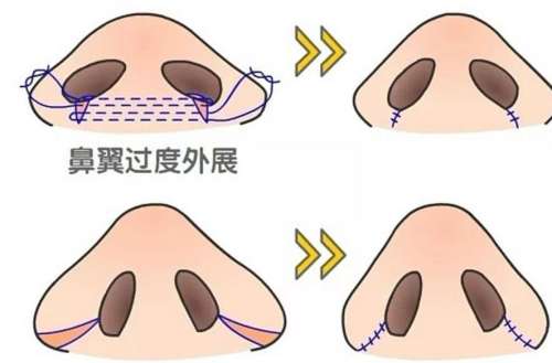 鼻翼缩小01.jpg 鼻翼缩小01.jpg
