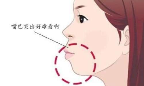 下巴后缩