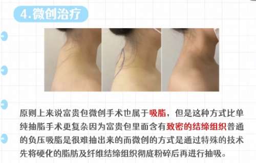 富贵包抽脂项目