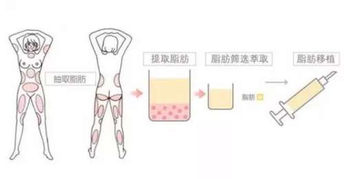 自体脂肪丰胸 (6).jpg