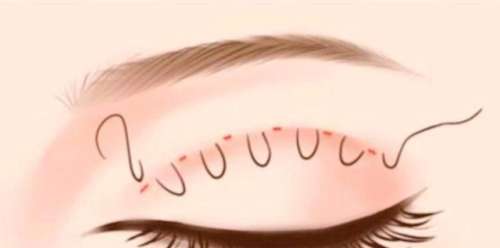 双眼皮 双眼皮