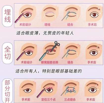双眼皮