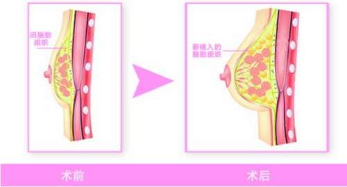 脂肪隆胸 脂肪隆胸