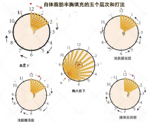 脂肪丰胸