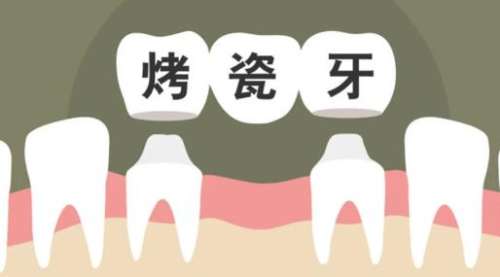 烤瓷牙01.jpg 烤瓷牙01.jpg