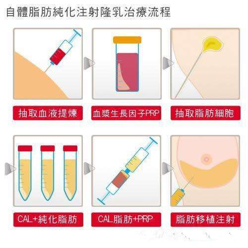 自体脂肪隆胸是什么1.jpg