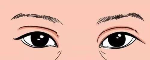 双眼皮修复01.jpg