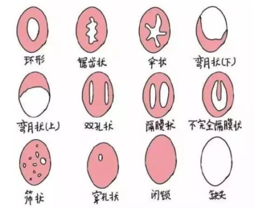 处女膜修复.png
