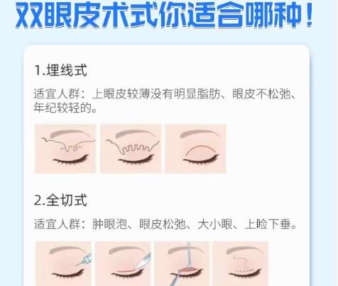 双眼皮