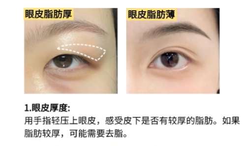 双眼皮