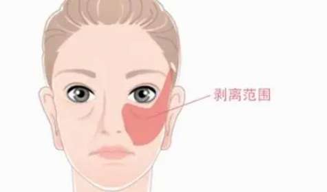 拉皮 拉皮