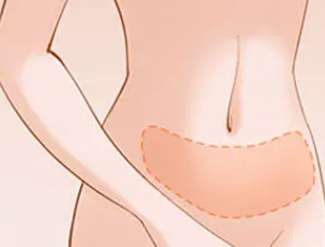 吸脂