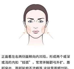 面颊凹陷