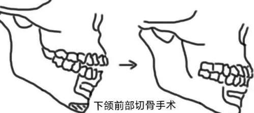 正颌 正颌