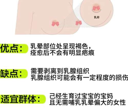 隆胸