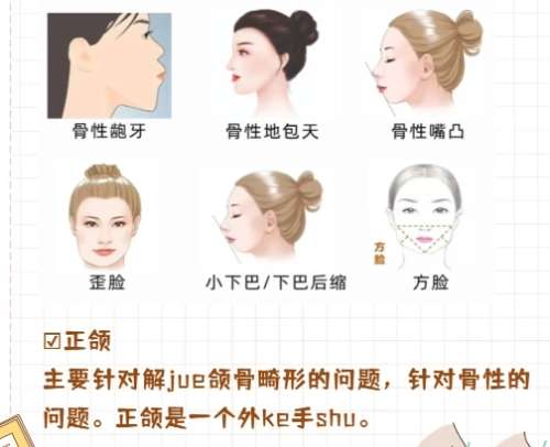 正颌手术