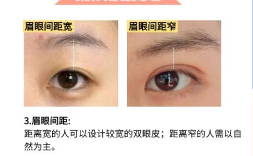 双眼皮 双眼皮