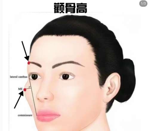 颧骨