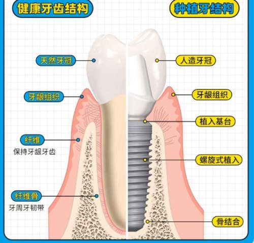 牙齿种植