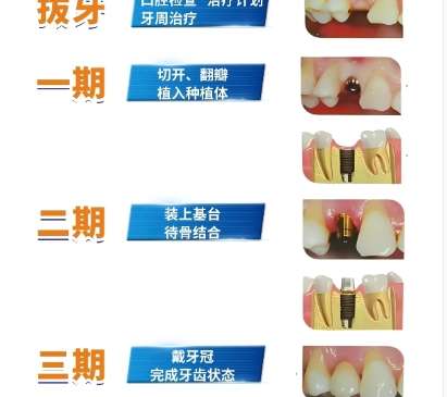 牙齿种植
