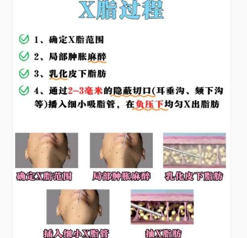 面吸 面吸