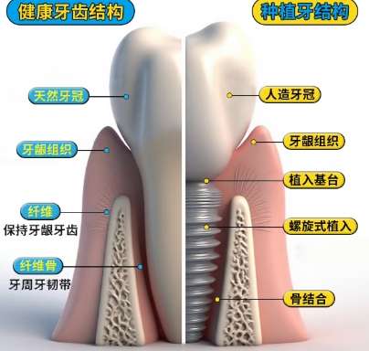 牙齿种植