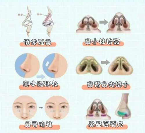 鼻综合