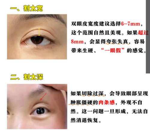 双眼皮11.jpg