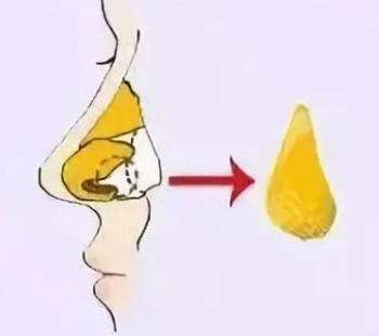 隆鼻