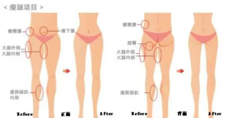 46吸脂.png