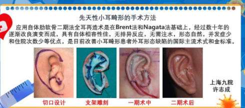 耳朵整形1.jpg 耳朵整形1.jpg