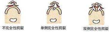 唇裂 唇裂