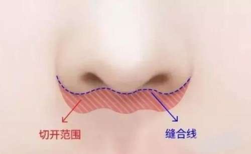 人中缩短