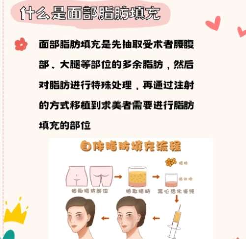 脂肪填充 脂肪填充