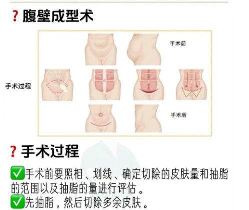 腹壁2.jpg 腹壁2.jpg