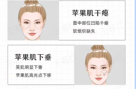 苹果肌
