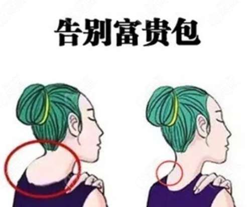 富贵包吸脂.jpg