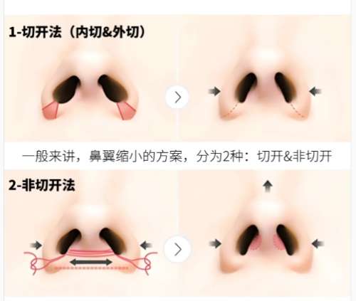 隆鼻
