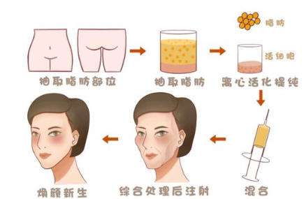 脂肪填充 脂肪填充
