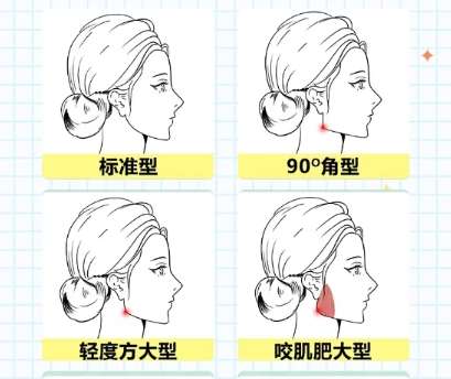 下颌角 下颌角