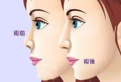 隆鼻动漫21.jpg 隆鼻动漫21.jpg